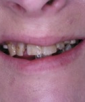 dental-implants-2-2