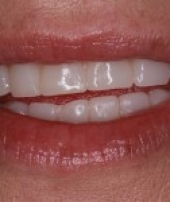 dental-implants-2-4