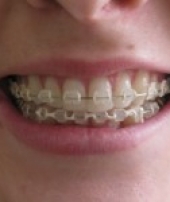 orthodontist-services-1-1
