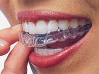 Invisalign orthodontic treatment